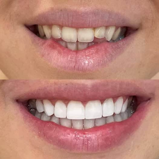 Κατερινα Βεργετη οδοντίατρος Αθήνα! Το πριν και το μετά απο την δουλειά της